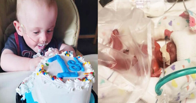 Το πιο πρόωρο μωρό του κόσμου γιόρτασε τα πρώτα γενέθλια