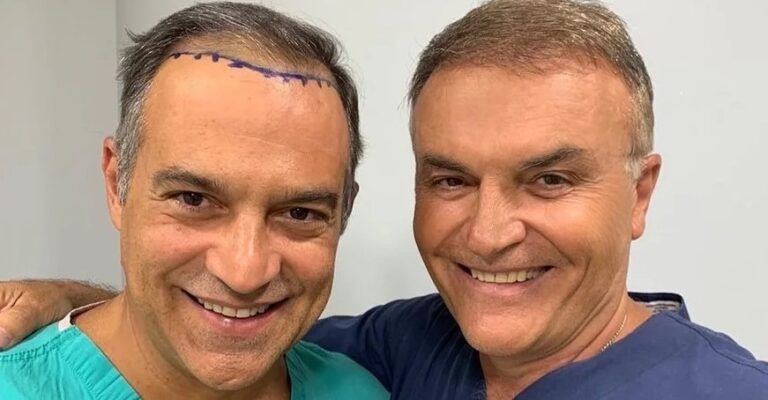 Ακομπλεξάριστος o Κρατερός Κατσούλης: Έκανε εμφύτευση μαλλιών και δείχνει το πριν και το μετά