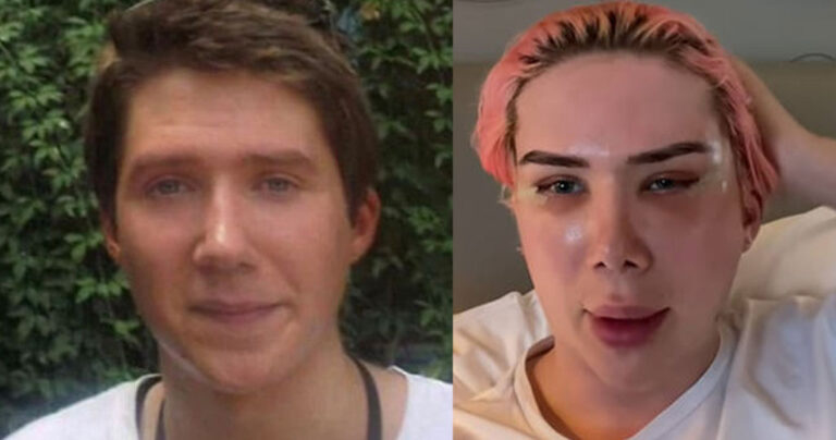 Βρετανός έκανε δεκάδες πλαστικές για να μοιάζει με Κορεάτη