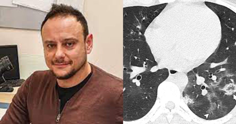 Μαγιορκίνης: Οι βλάβες στους πνεύμονες ανηλίκων που νόσησαν με κορονοϊό – «Θέλετε να δείτε πόσα χρόνια θα χάσετε;»