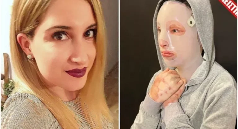 Επίθεση με βιτριόλι: Η Ιωάννα δημοσίευσε για πρώτη φορά φωτογραφία χωρίς μάσκα