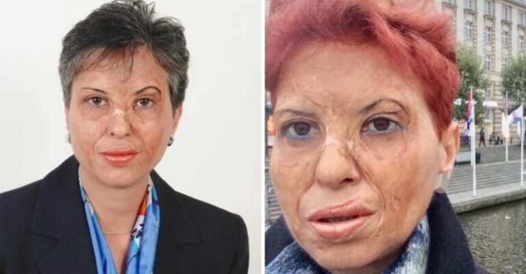 Καλλιόπη Αθανασιάδη: Η επιζήσασα ενός φριχτού ατυχήματος που έγινε η κορυφαία χειρούργος της Ελλάδας