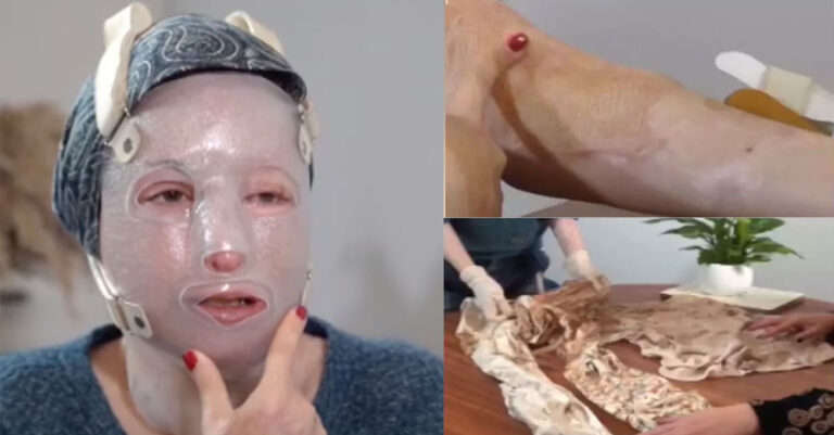 Συγκλονίζει η Ιωάννα Παλιοσπύρου: Δείχνει πρώτη φορά τα σημάδια από το βιτριόλι και τα κατεστραμμένα ρούχα από τη μοιραία επίθεση