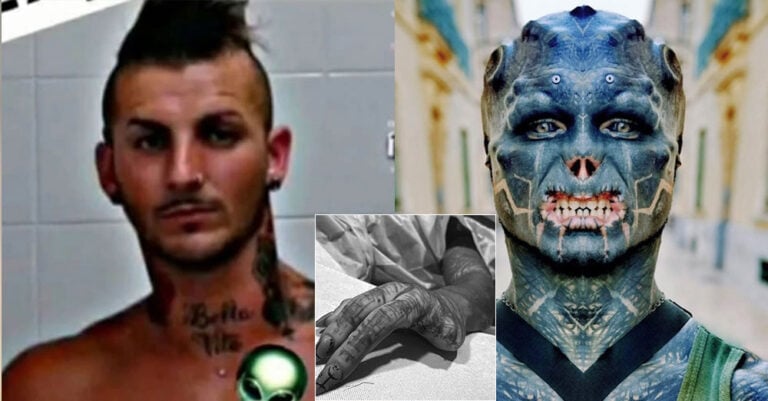 Γάλλος αφαίρεσε δύο δάχτυλα για να μοιάζει καλύτερα με εξωγήινο