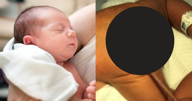 Γεννήθηκε μωρό με ουρά 12 εκατοστών στη Βραζιλία – Πολύ σπάνια περίπτωση