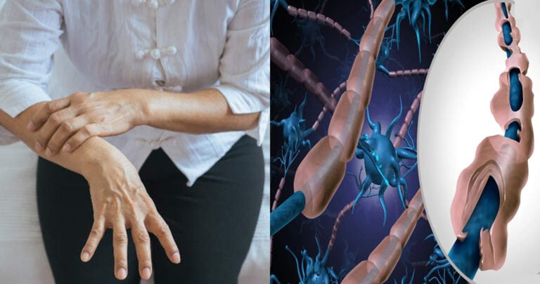 Τι είναι το σύνδρομο Guillain-Barré: Οι πολύ σοβαρές επιπτώσεις και τα πρώτα σημάδια – Ποιοι κινδυνεύουν κυρίως