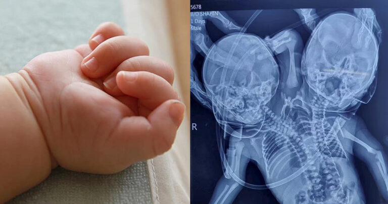 Γεννήθηκε μωρό με δύο κεφάλια, τρία χέρια και δύο καρδιές