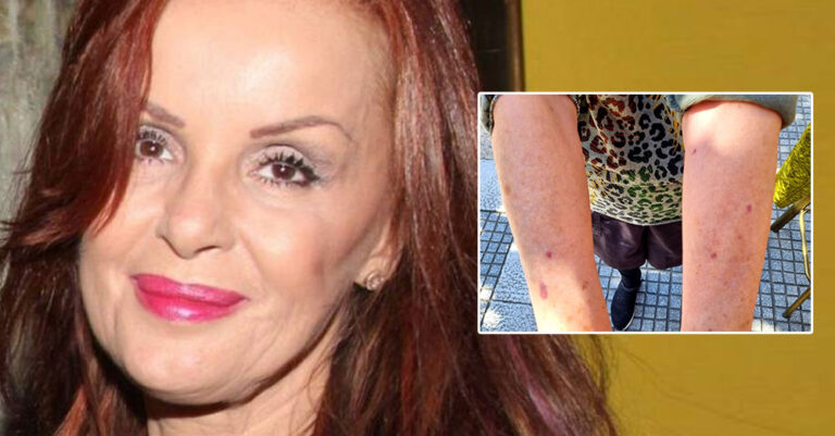 Xρυσηίδα Δημουλίδου: «Οι μελανιές στα χέρια μου επακόλουθο του εμβολίου της Pfizer»