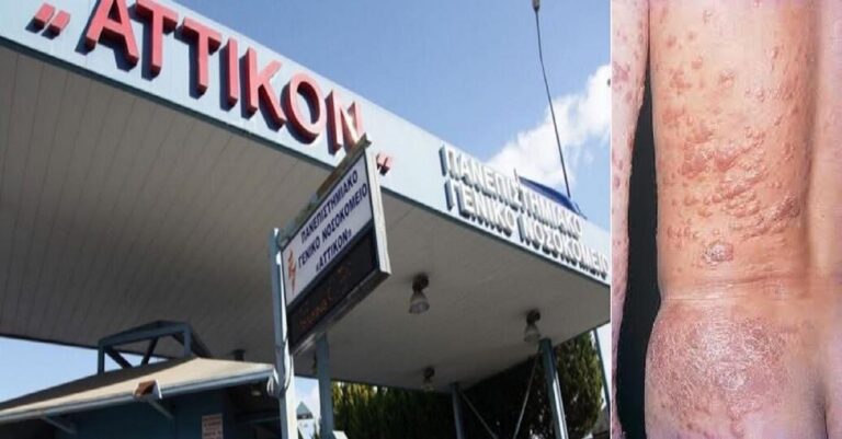 Κρούσμα λέπρας νοσηλεύεται στο νοσοκομείο «Αττικόν»-Έλληνας από την Πελοπόννησο