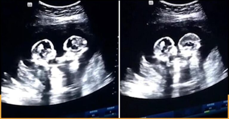 Δίδυμα «τσακώνονται» από την κοιλιά της μαμάς: Το υπερηχογράφημα που έγινε viral