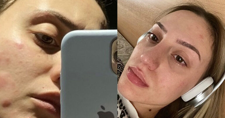 «Γροθιά στο στομάχι» οι φωτογραφίες της Άννας Κορακάκη με τα σημάδια στο πρόσωπό της