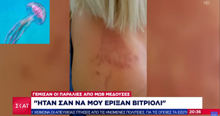 «Σαν να μου έριξαν βιτριόλι, ο πόνος δεν περιγράφεται» – Σοκάρει γυναίκα που έπεσε θύμα μωβ μέδουσας