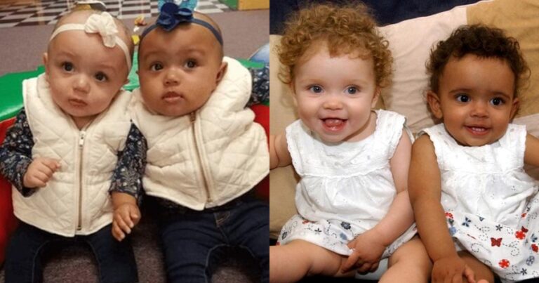 Δίδυμα κορίτσια, γεννήθηκαν με διαφορετικό χρώμα και 20 χρόνια μετά δεν μοιάζουν καν με αδερφές
