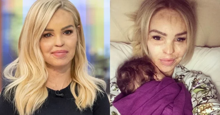 Δύναμη ψυχής: Την κακοποίησαν, της έριξαν βιτριόλι στο πρόσωπο και σήμερα είναι παρουσιάστρια στην τηλεόραση