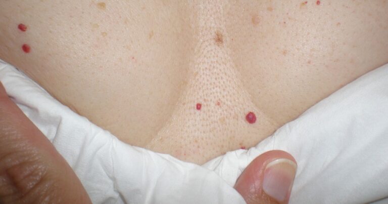 Τι είναι οι κόκκινες ελιές στο σώμα μας, πότε εμφανίζονται και τι σημαίνουν για την υγεία μας