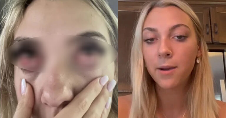 Έβαλε ψεύτικες βλεφαρίδες και έπαθε αλλεργική αντίδραση – «Έμοιαζα με ζόμπι, ντρεπόμουν να κυκλοφορήσω για ένα μήνα»