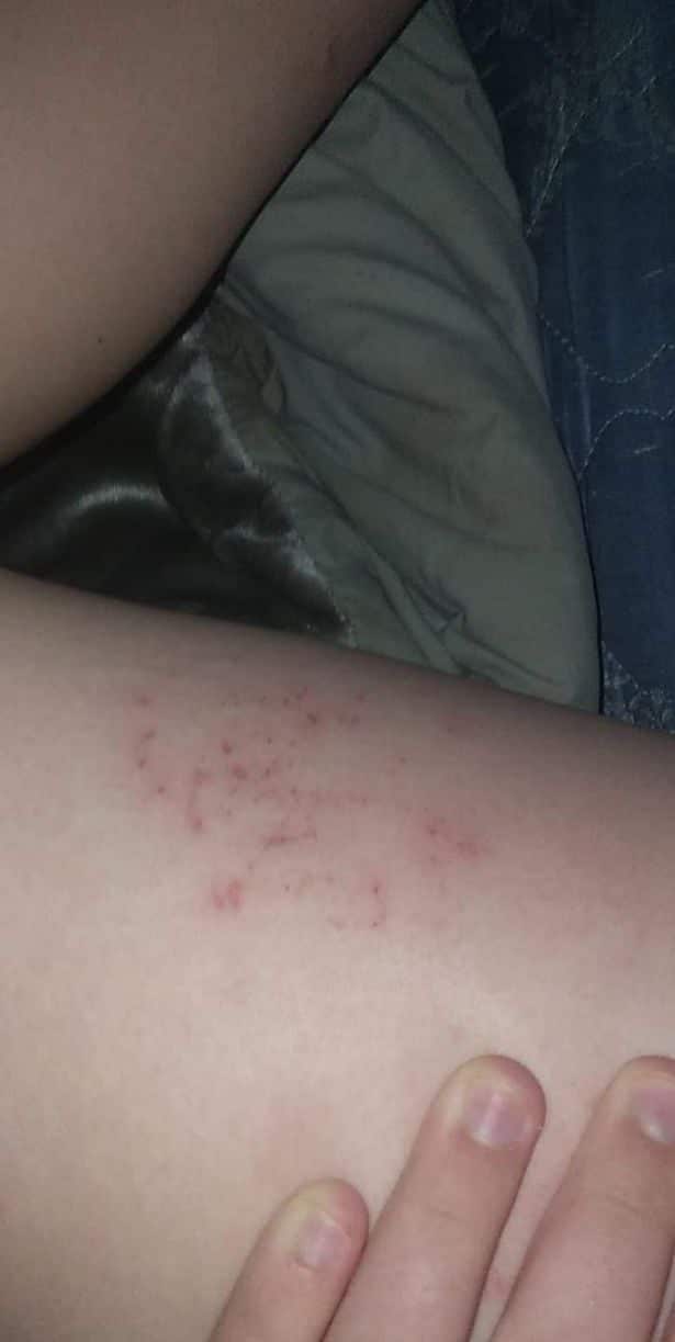 0 teen water allergy hives