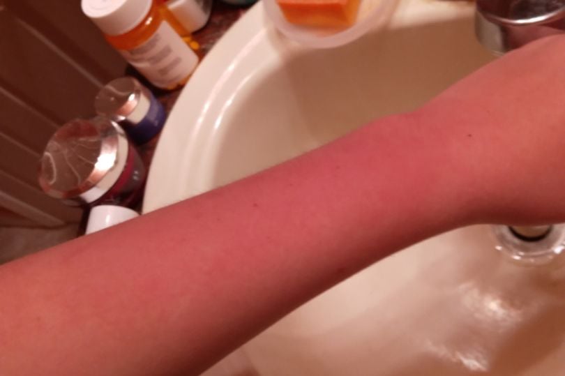 1 teen with water allergy