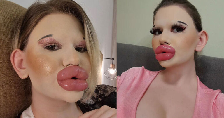 Μοιάζει με «κούκλα Barbie» από 19 ετών και δεν σταματά τις πλαστικές επεμβάσεις – «Πάντα γυρίζουν για να με κοιτάξουν»