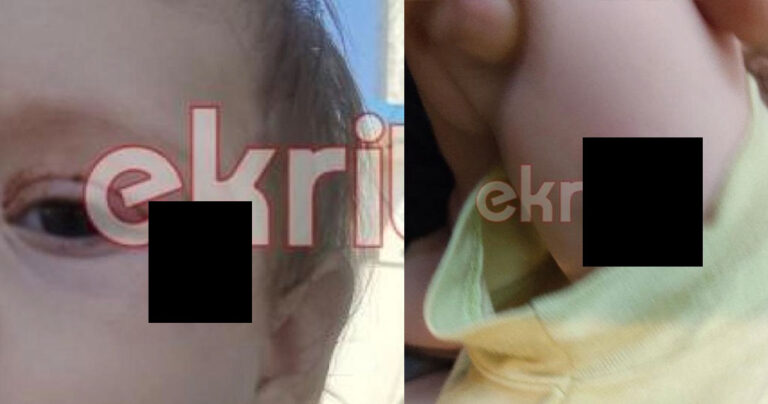 Κρήτη: Eικόνες-σοκ από τα δαγκώματα του λυκόσκυλου στο 8 μηνών αγοράκι
