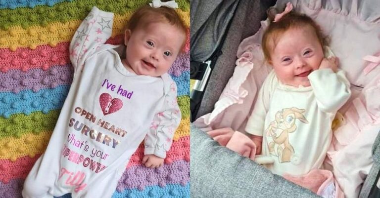 Σύνδρομο Down: Νέα ορμονοθεραπεία προσφέρει ελπίδες στους ασθενείς