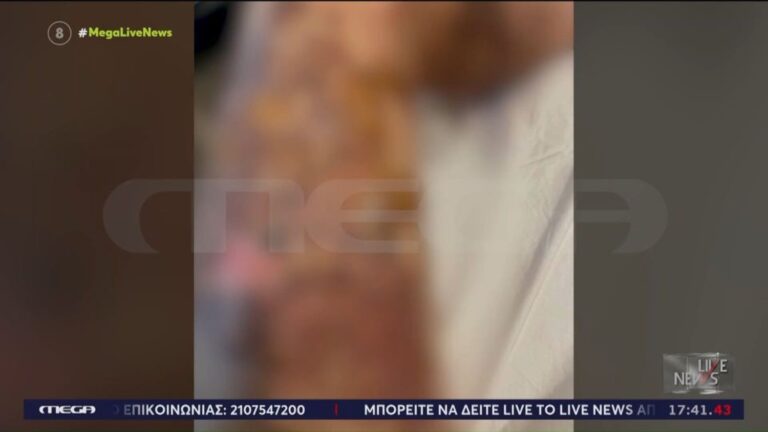 «Θυμήθηκα την Παλιοσπύρου»: 35χρονη με εγκαύματα 3ου βαθμού μετά από έκρηξη αποφρακτικού
