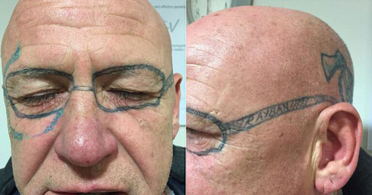 Ουαλός μέθυσε πολύ και ξύπνησε την άλλη μέρα με τατουάζ γυαλιών ηλίου στο πρόσωπό του