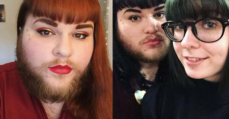 Γυναίκα σταμάτησε να ξυρίζει το πρόσωπό της μετά από 10 χρόνια επειδή ερωτεύθηκε