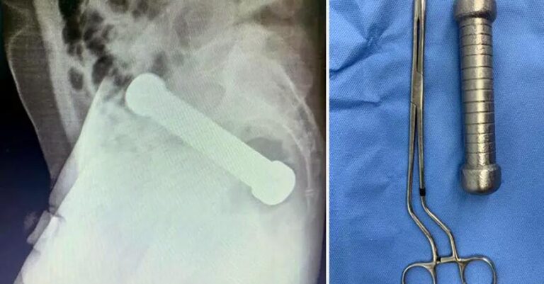 Άνδρας έβαλε βαράκι 2 κιλών στον πpωκτό του – Έμεινε εκεί για 2 μέρες μέχρι να χειρουργηθεί