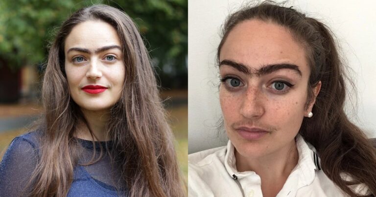 31χρονη σταμάτησε να βγάζει φρύδια και μουστάκι επειδή νιώθει εξίσου θηλυκή με τις τρίχες της