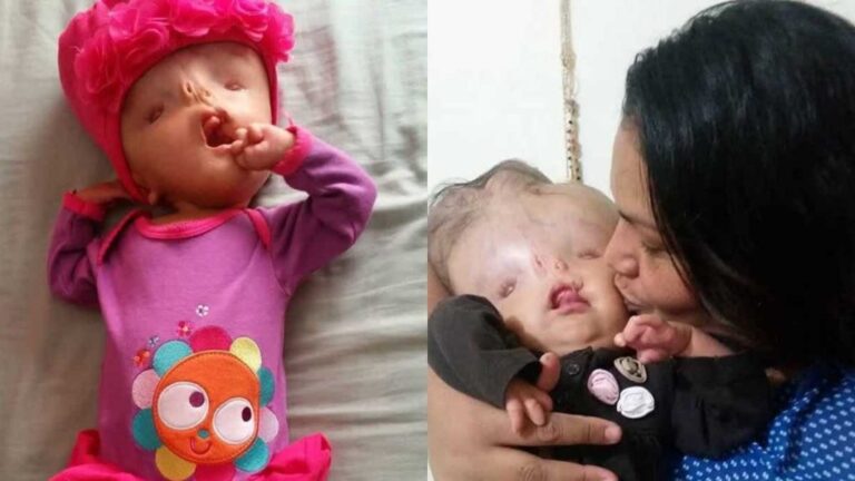 «Δεν είναι εξωγήινος το παιδί μου, είναι μία πραγματική μαχήτρια»: Μία συγκλονιστική ιστορία