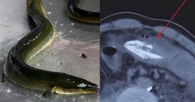 Κινέζος έβαλε στον πpωκτó του χέλι 20 εκ. για να θεραπευτεί από την δυσκοιλιότητα