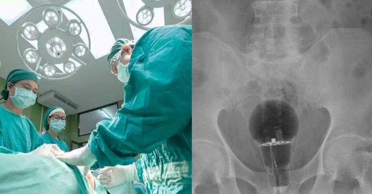 Έκαναν τον σταυρό τους οι γιατροί: Ασθενής εισήλθε στο νοσοκομείο με έναν λαμπτήρα στον πpωκτó του