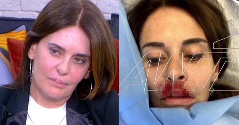 «Δεν μπορώ να πιώ χωρίς καλαμάκι»: Έλληνας πλαστικός κατέστρεψε τα χείλη της συγγραφέα, Κατερίνας Πλουμιδάκη