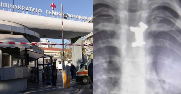 Γιατροί στο Ιπποκράτειο έσωσαν αγοράκι που κατάπιε μεταλλικό σκυλάκι
