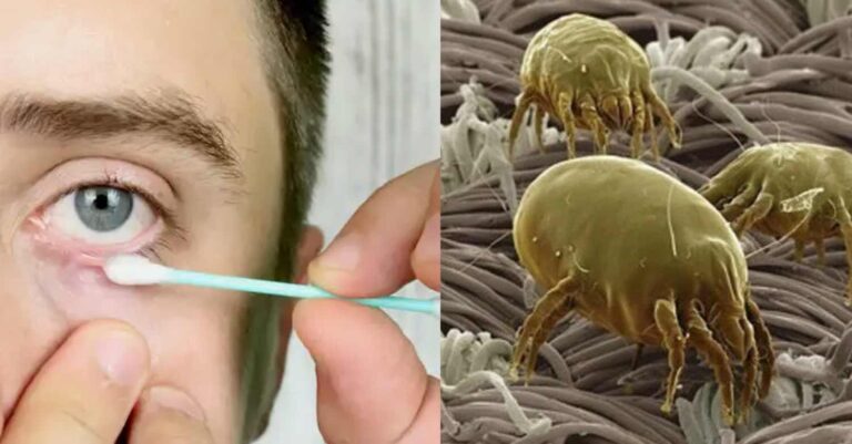 Αν νιώσετε αυτά στο μάτι, τότε μάλλον είναι ακάρεα στις βλεφαρίδες