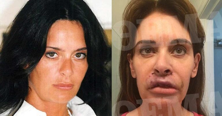 Ελληνίδα συγγραφέας είδε τα χείλη της να «σαπiζουν» μετά από πλαστική επέμβαση