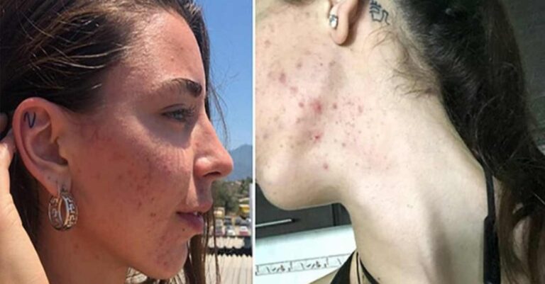 27χρονη πρώην βίγκαν εξομολογείται: «Ήμουν συνέχεια άρρωστη, μου έπεσαν τα μαλλιά. Έφαγα κρέας και σώθηκε η ζωή μου»
