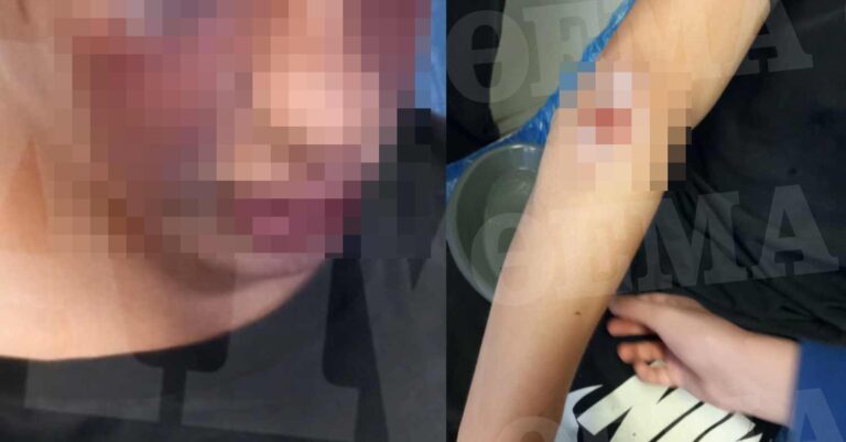 Καλαμάτα: «Τον κάνανε τσουβάλι στις κλωτσιές» λένε οι γονείς του 16χρονου που ξυλοκοπήθηκε από συμμορία ανηλίκων