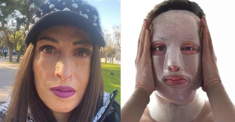 Iωάννα Παλιοσπύρου: Τρία χρόνια από την επίθεση με το βιτριόλι που σόκαρε τη χώρα – Δημοσίευσε εικόνες που σοκάρουν