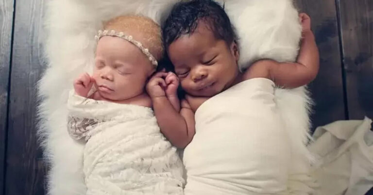 Πώς μια μητέρα γέννησε ετερόχρωμα δίδυμα