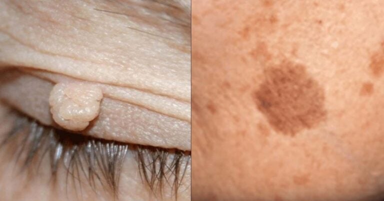 15 φυσικοί τρόποι για να απαλλαγείτε άμεσα από κηλίδες στο δέρμα, κρεατοελιές και σπυράκια