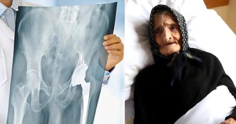 «Έμειναν άφωνοι» οι γιατροί με 99χρονη γιαγιά μετά από εγχείρηση για κάταγμα ισχύου στο νοσοκομείο Μυτιλήνης