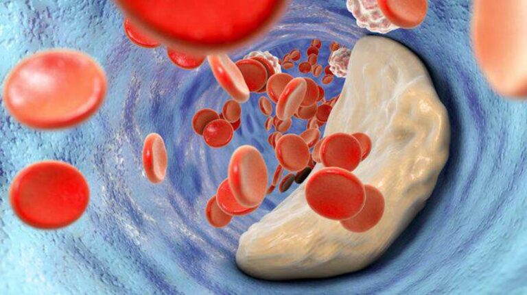 Μήπως έχετε φpαγμένες αρτηρiες; Κάντε το τεστ με το μαξıλάρι