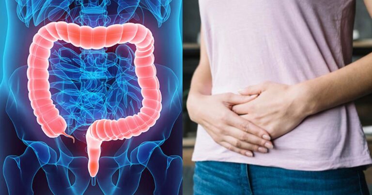 Πολύποδες Παχέος Εντέρου: Τα ένοχα τρόφιμα που πρέπει να αποφεύγουμε