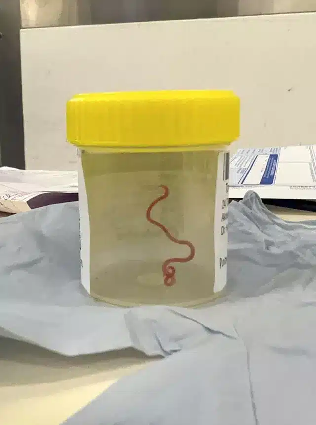 surgeon probing australian woman s mystery symptoms finds live worm in her brain