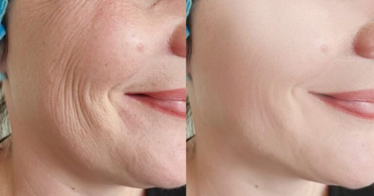 Μπóτοξ της φύσης: 8 τροφές για αναπλήρωση του κολλαγόνου στο δέρμα και μείωση των ρυτiδων με φυσικό τρόπο