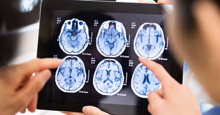 Το νο.1 σύμπτωμα όγκου στον εγκέφαλο για το οποίο οι περισσότεροι απλά δεν δίνουν σημασία