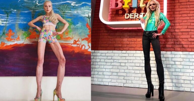 Ξόδεψε 150.000€ για να μακρύνει τα πόδια της 14 εκατοστά, τελικά το μετάνιωσε: «Δεν το ήθελα», λέει το 31χρονο μοντέλο