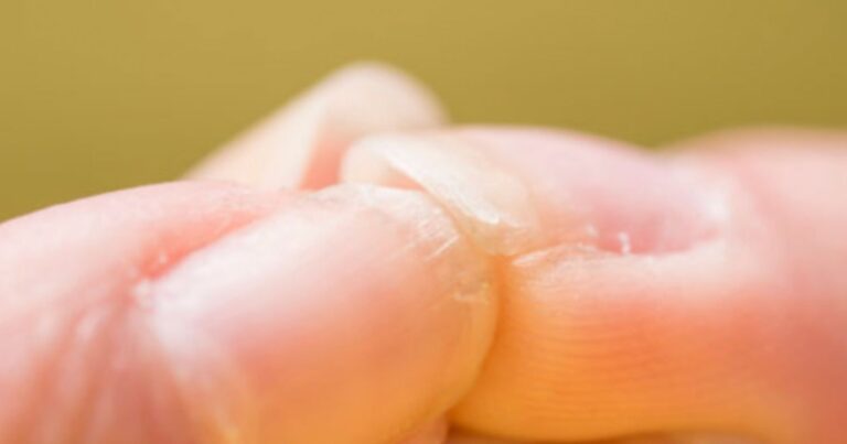 Αν τα νύχια σας είναι όπως σε αuτές τις εικόνες – 5 προβλήματα που μπορεί να εκδηλωθούν